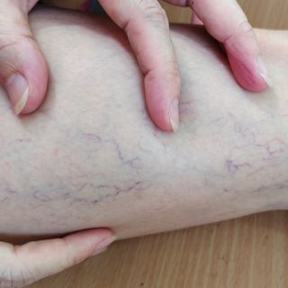 Zmniejsza ból i obrzęki