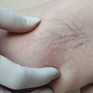 Eliminuje widoczne żyły i pajączki