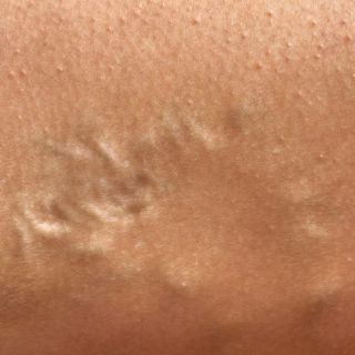 Zapobiega powstawaniu nowych żylaków